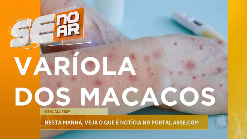  Atalaia 360° A8SE destaca caso suspeito de varíola dos macacos em Sergipe – A8SE.com