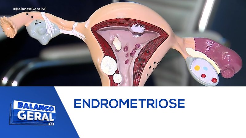  Mais de 7 milhões de brasileiras sofrem com a endometriose – A8SE.com